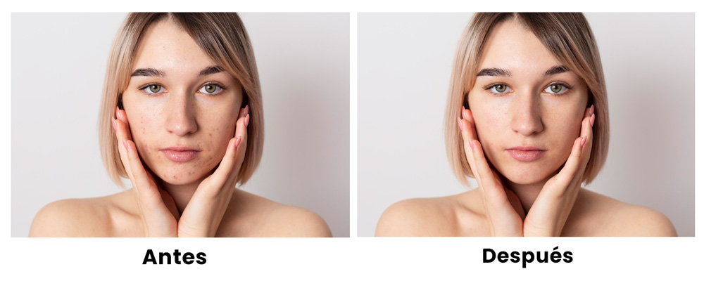 Retoque Fotográfico de piel